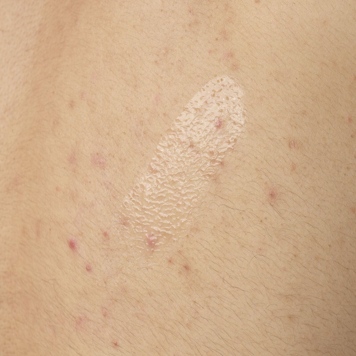salicylic-acid-0-5-body-serum-p2 ORD-salicylic-acid-05-body-240ml-application.jpg