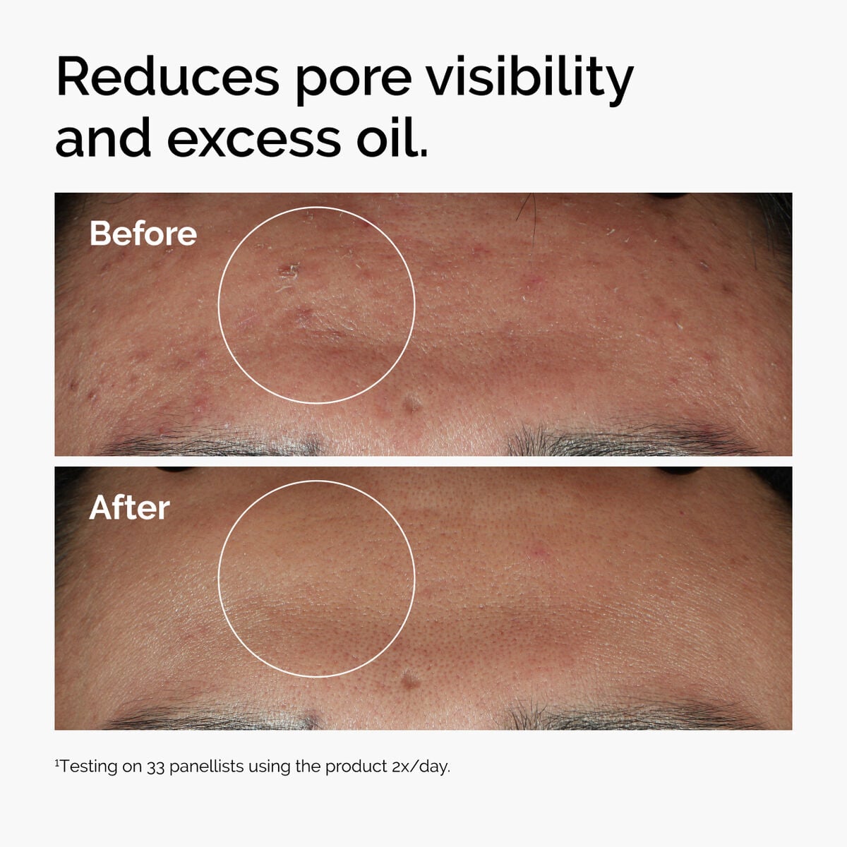 niacinamide-10-zinc-1-n7 ord-niacinamide-zinc-blemish-serum-before-after-pores.jpg