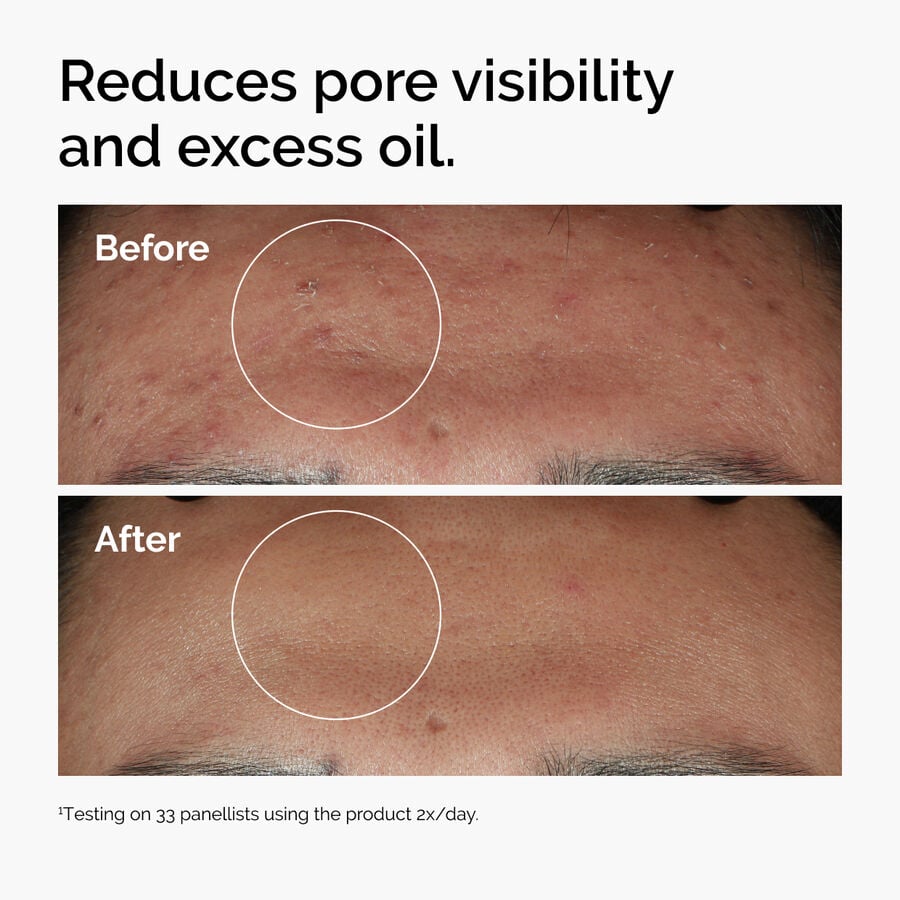 niacinamide-10-zinc-1-r9 ord-niacinamide-zinc-blemish-serum-before-after-pores.jpg