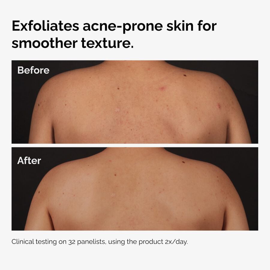salicylic-acid-0-5-body-serum-p2 ord-salicylic-acid-body-serum-before-after-graphic-NA.jpg